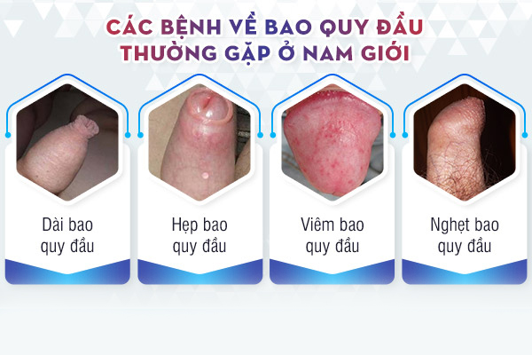 Các bệnh bao quy đầu thường gặp 