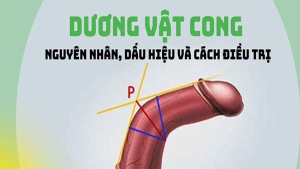 Dương vật bị cong là gì? Khắc phục tình trạng dương vật cong hiệu quả