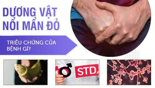 Dương vật nổi mẩn đỏ là triệu chứng của bệnh gì?