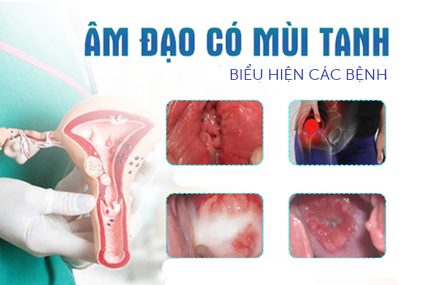 Âm đạo có mùi hôi là biểu hiện của bệnh gì?