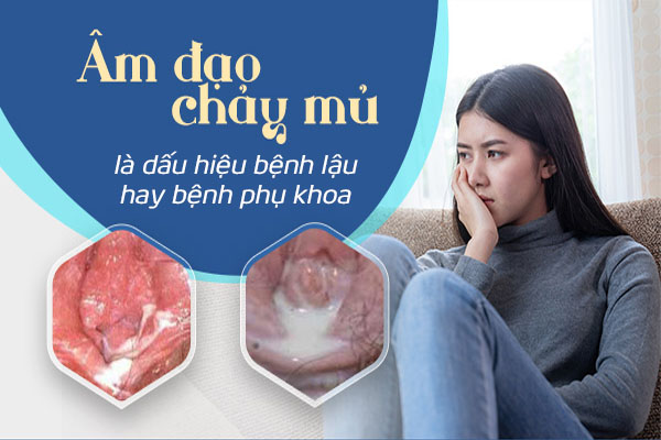 Âm đạo ra mủ là dấu hiệu bệnh lậu hay bệnh phụ khoa