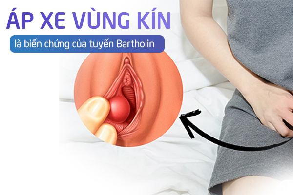 Áp xe vùng kín là biến chứng của tuyến Bartholin