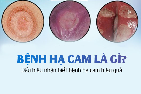 Bệnh hạ cam là gì? Dấu hiệu nhận biết bệnh hạ cam hiệu quả
