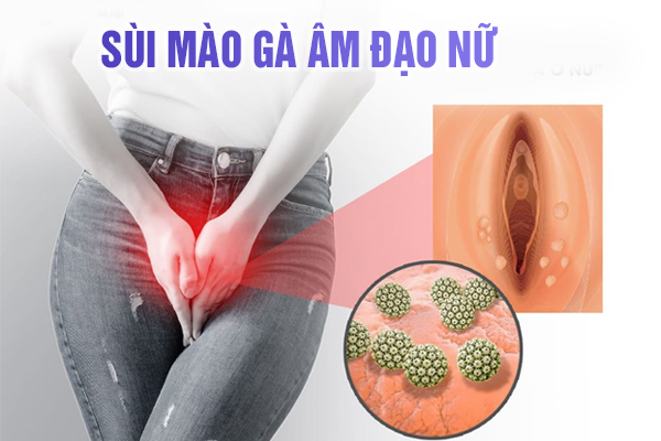 Bệnh sùi mào gà âm đạo ở nữ giới