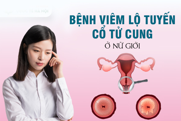 Bệnh viêm lộ tuyến cổ tử cung ở nữ giới