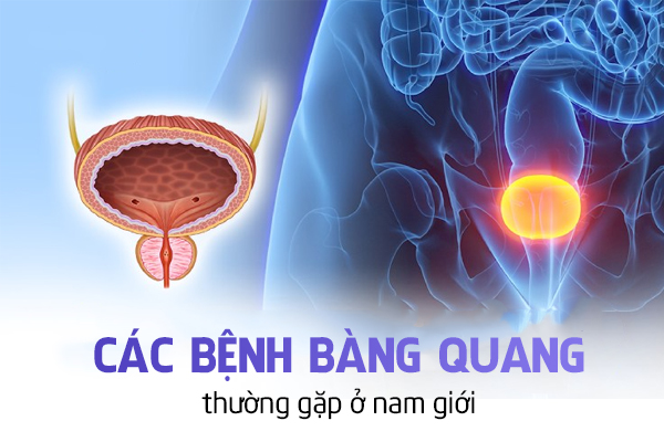 Các bệnh bàng quang thường gặp ở nam giới