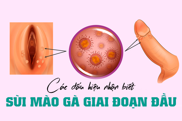 Các dấu hiệu bệnh sùi mào gà giai đoạn đầu