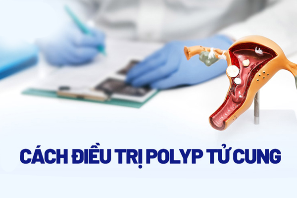 Các phương pháp chữa trị Polyp cổ tử cung hiệu quả