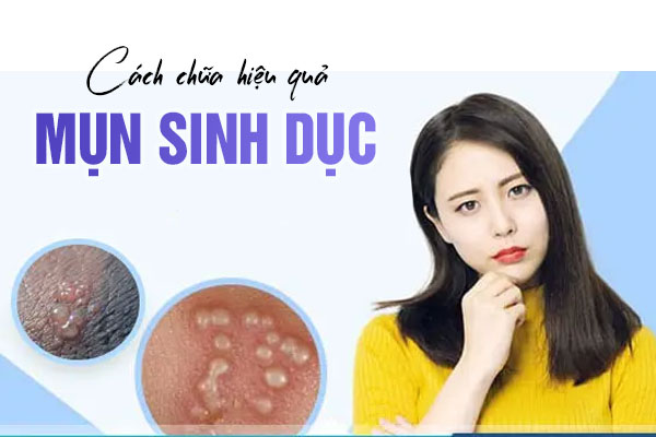 Cách chữa mụn sinh dục hiệu quả