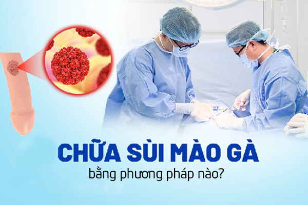Chữa trị sùi mào gà bằng phương pháp nào?