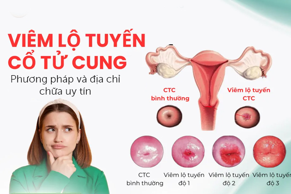 Chữa trị viêm cổ tử cung: Phương pháp và địa chỉ uy tín