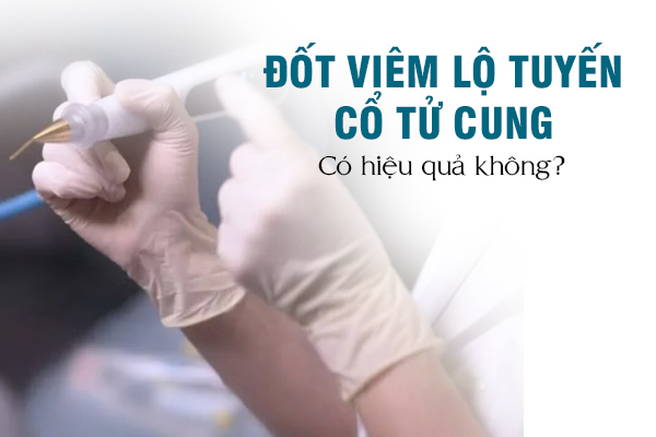 Đốt viêm lộ tuyến có hiệu quả không?