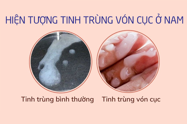 Hiện tượng tinh trùng vón cục ở nam giới