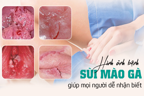 Hình ảnh sùi mào gà giúp mọi người dễ nhận biết