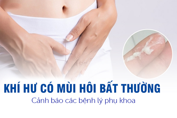 Khí hư có mùi hôi bất thường – Cảnh báo các bệnh lý phụ khoa