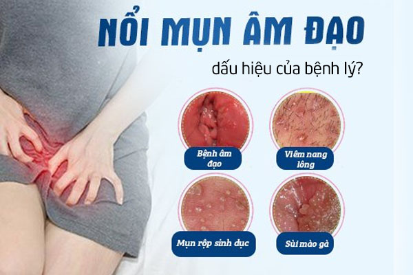 Mụn âm đạo là dấu hiệu bệnh lý gì?