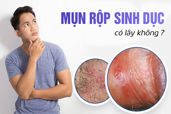 Mụn rộp sinh dục có lây không?