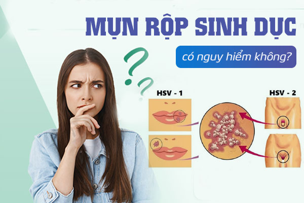 Mụn rộp sinh dục có nguy hiểm không?