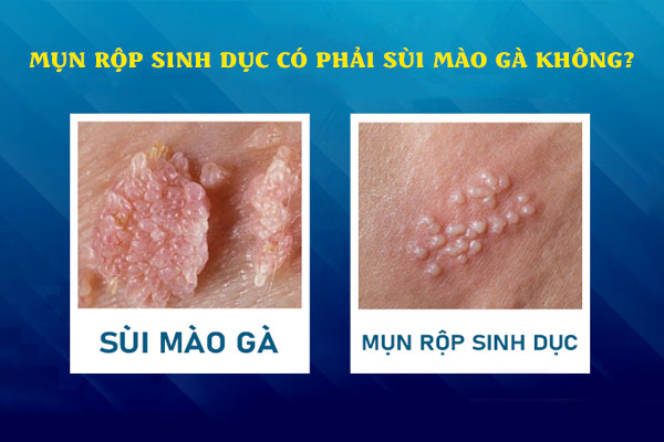 Mụn rộp sinh dục có phải sùi mào gà không?