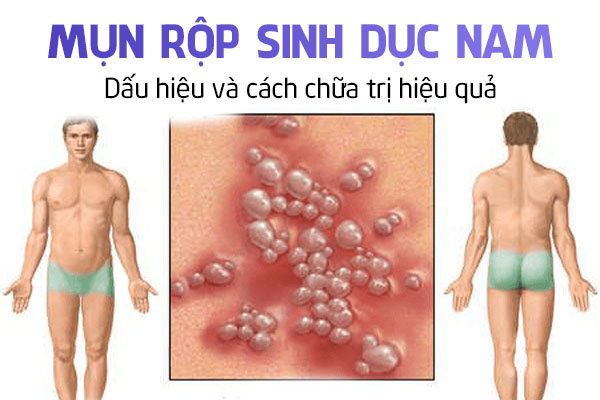 Mụn rộp sinh dục nam: Dấu hiệu và cách chữa trị hiệu quả