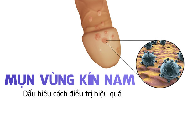 Mụn vùng kín nam: Dấu hiệu & cách điều trị hiệu quả