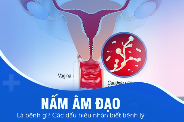 Nấm âm đạo là bệnh gì? Các dấu hiệu nhận biết bệnh lý