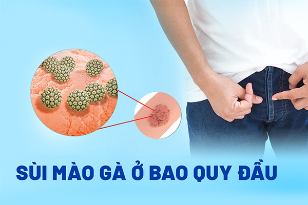 Nam giới bị sùi mào gà ở bao quy đầu