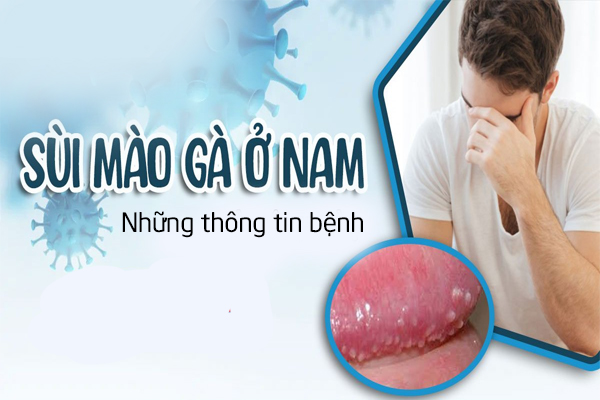Những thông tin bệnh sùi mào gà ở nam