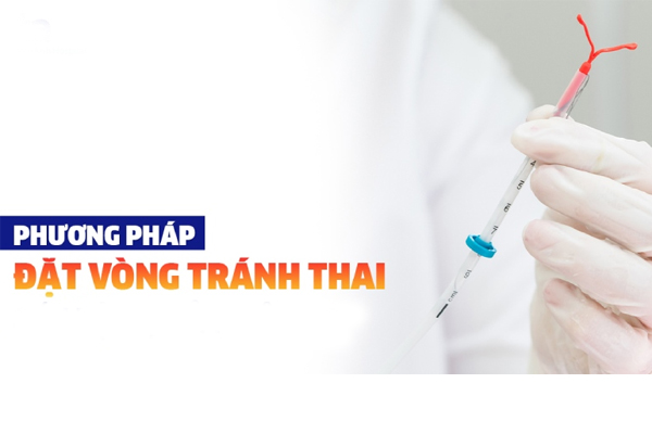 Những thông tin về biện pháp đặt vòng tránh thai