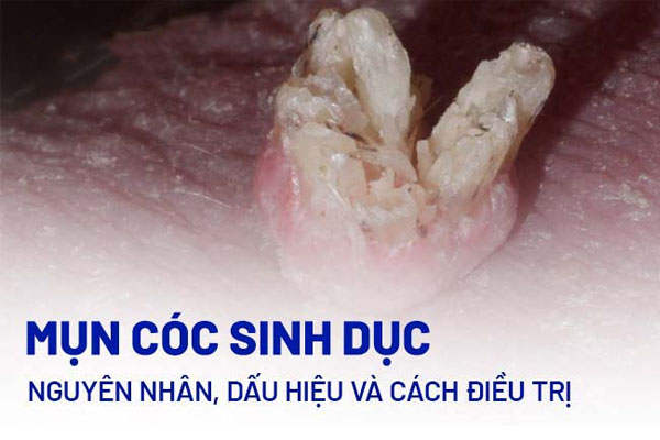 Những thông tin về mụn cóc sinh dục