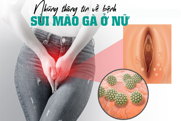 Những thông tin về sùi mào gà ở nữ
