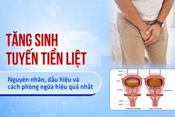 Những thông tin về tăng sinh tuyến tiền liệt