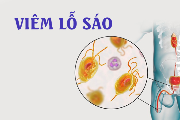 Những thông tin về tình trạng viêm lỗ sáo