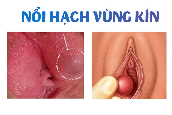 Nổi hạch vùng kín là bệnh gì?