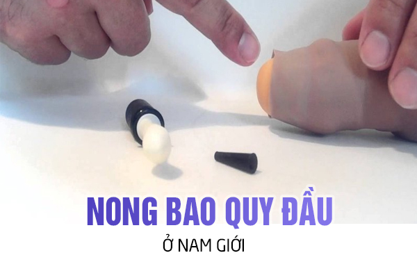 Nong bao quy đầu ở nam giới