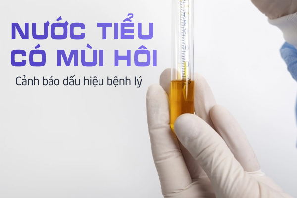 Nước tiểu có mùi hôi dấu hiệu bệnh lý