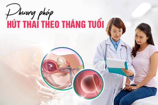Phương pháp hút thai theo tháng tuổi