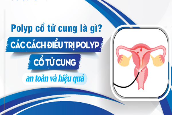 Polyp cổ tử cung là gì? Các phương pháp điều trị polyp hiệu quả