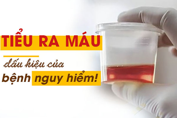 Tiểu ra máu cảnh báo bệnh lý nguy hiểm nào?