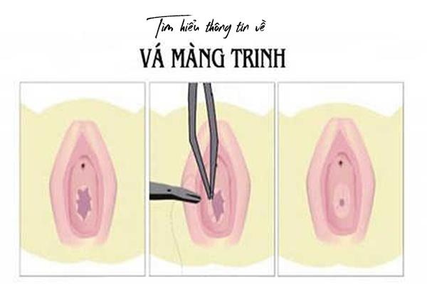 Tìm hiểu những thông tin về vá màng trinh