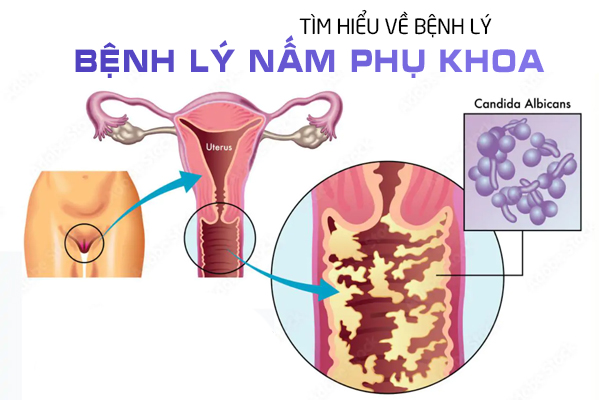 Tìm hiểu về bệnh lý nấm phụ khoa ở nữ giới