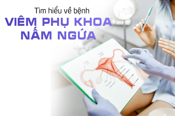 Tìm hiểu về bệnh viêm phụ khoa nấm ngứa