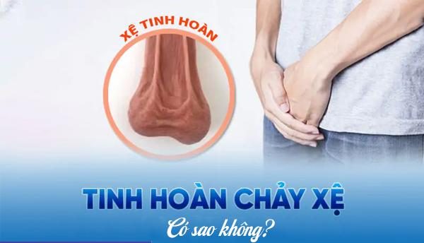 Tinh hoàn chảy xệ có sao không?