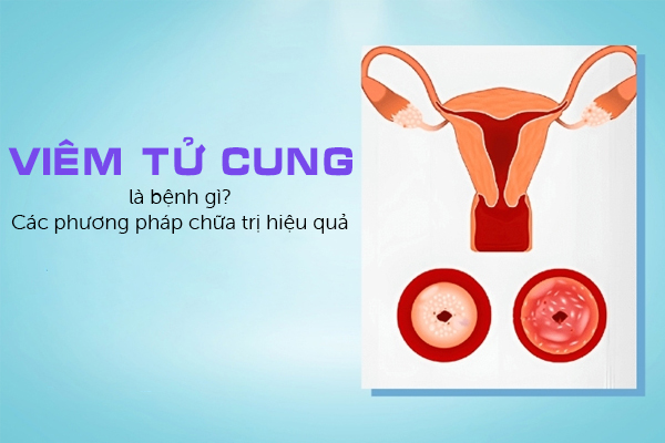 Viêm tử cung là bệnh gì? Các phương pháp chữa trị hiệu quả