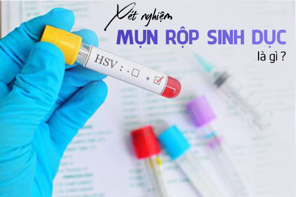 Xét nghiệm mụn rộp sinh dục là gì? 