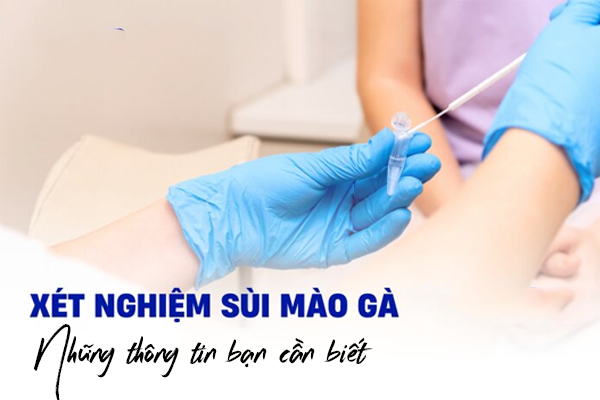 Xét nghiệm sùi mào gà – Những thông tin bạn cần biết