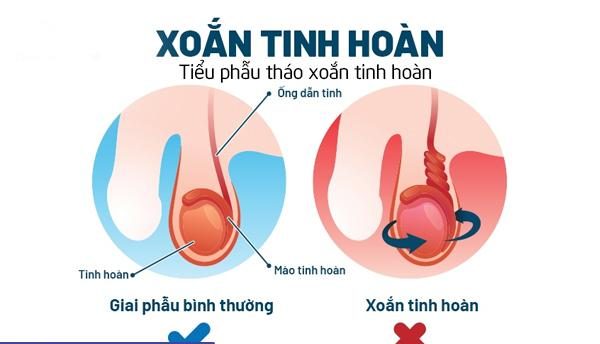 Xoắn tinh hoàn là gì? Tiểu phẫu tháo xoắn tinh hoàn