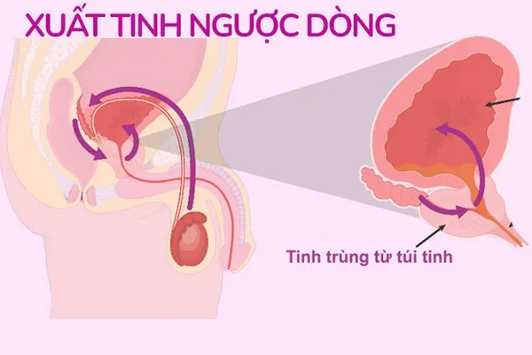 Xuất tinh ngược dòng – dấu hiệu của chứng rối loạn xuất tinh