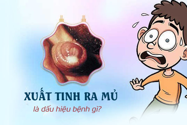 Xuất tinh ra mủ là dấu hiệu bệnh gì?