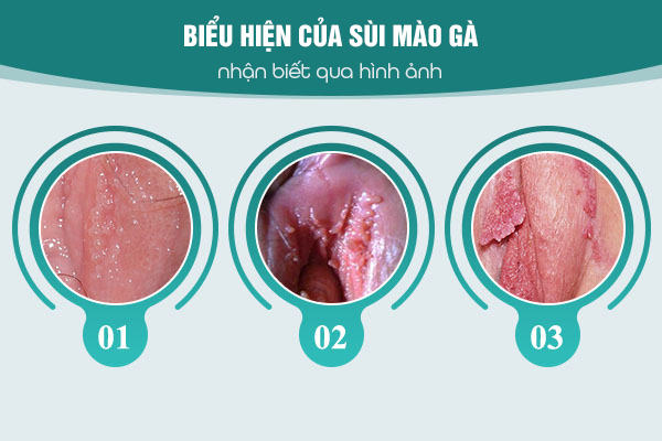 Biểu hiện của sùi mào gà nhận biết qua hình ảnh